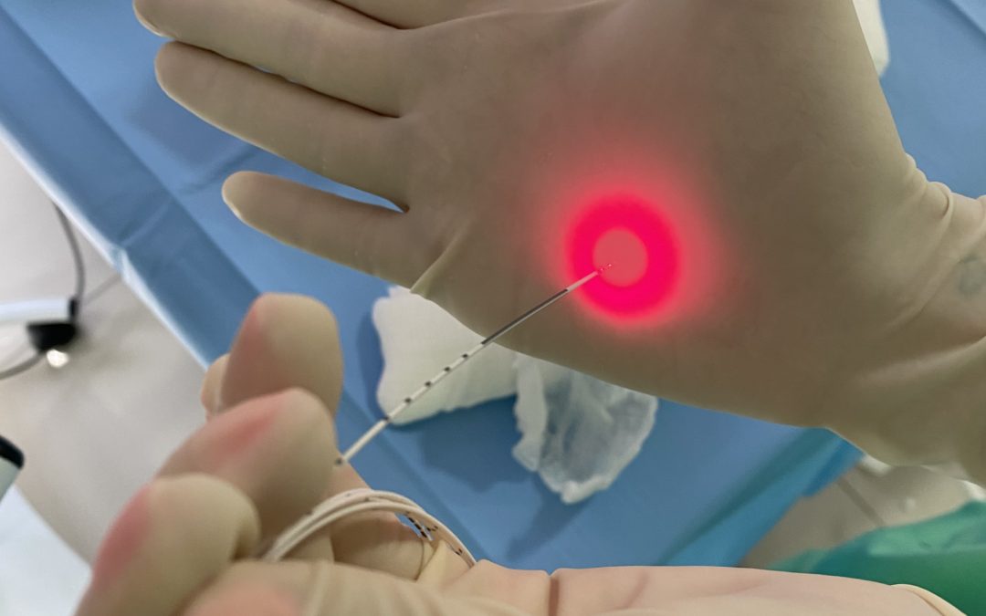 Laser e tratamento de Varizes