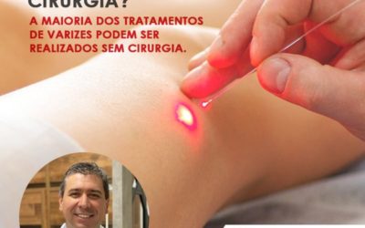 varizes sem cirurgia